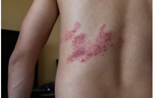 alt text: "Herpes outbreak on Richard's body"